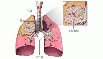 小细胞肺癌的最佳治疗方法介绍 