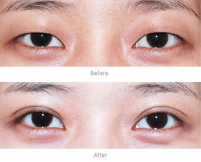 韩式双眼皮图片 