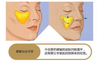 玻尿酸填充法令纹越填越深 为什么 
