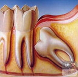 智齿冠周炎治疗小秘方 为大家推荐一些小秘方