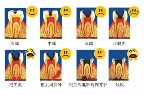 你觉得轻微蛀牙能通过刷牙刷掉吗为什么