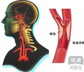 脑动脉硬化的鉴别诊断 脑动脉硬化的特征