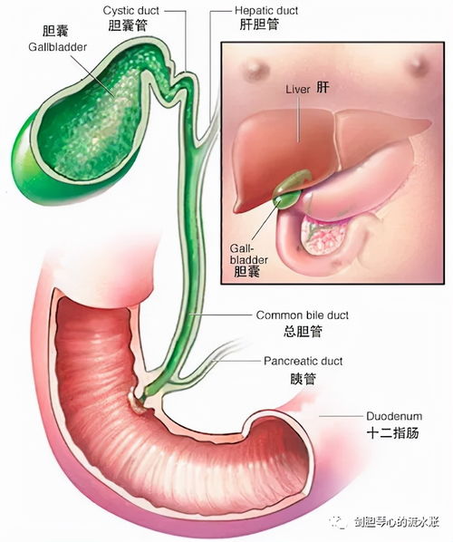 一文带你了解胆管内乳头状瘤