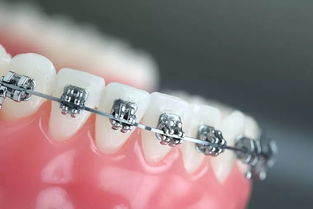 ***牙套和钢丝牙套哪个效果更好 牙齿***矫正和钢丝牙套有什么区别吗？ 