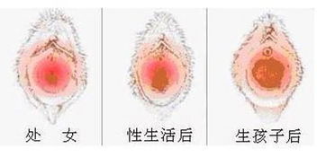 科普图解 处女膜在阴道什么位置