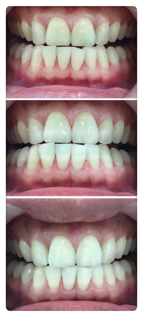 冷光美白牙齿副作用 冷光美白牙齿后悔了 冷光美白牙齿的副作用