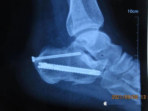 新技术 泉州仁福骨外科医院成功开展跟骨钉中钉系统微创手术
