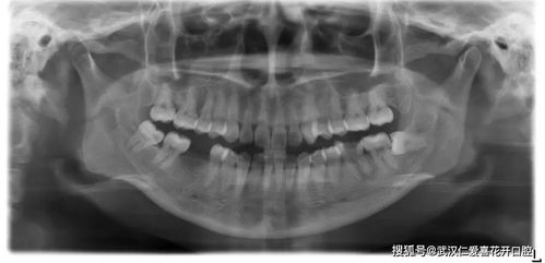 种牙亲身经历分享 历时4个月 ,解决年轻人的蛀牙缺牙烦恼