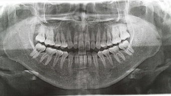 有没有专业人士能帮我看看我这牙片子到底牙槽骨吸收严重不严重需不需要做那个翻瓣手术啊 由於对现在医 