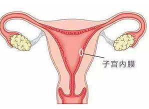 子宫内膜薄怎么治疗