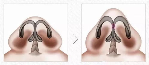 什么样的鼻子适合鼻综合,鼻综合的原理是什么