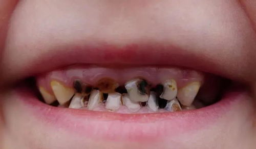 牙齿烂到只剩牙根,拔还是不拔 真的很重要 口腔 牙冠 发展 