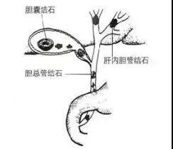 胆囊结石会诱发胰腺炎吗 关于结石的4个真相 