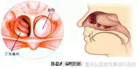 重庆弘医堂耳鼻喉医院讲解 鼻息肉引发的危害有哪些呢