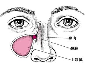 额窦炎的预防 