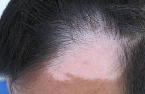 头部白癜风患者染发,有2个危害,还会加速白斑扩散