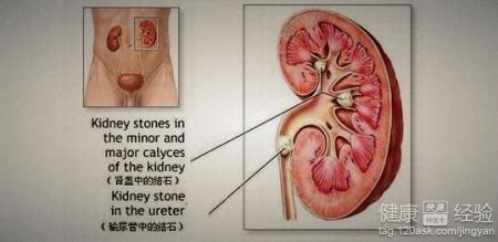 哪些因素会导致肾结石的发生呢