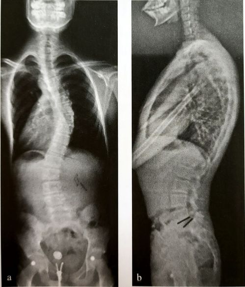 青少年脊椎滑脱伴脊柱侧凸 哪些情况需要手术干预