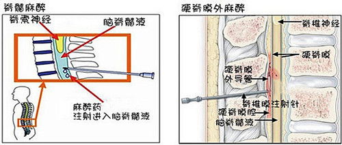 孕妇打无痛分娩针后死亡 医院称是羊水栓塞导致