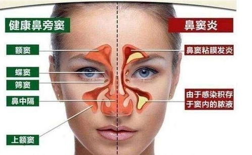 青少年的 健康杀手 鼻窦炎