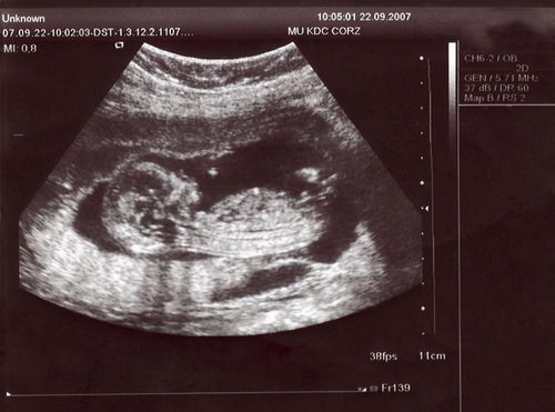 4个月胎儿性别图片图片
