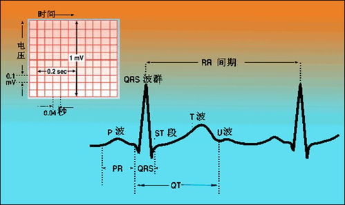 心电监护中常见异常波形的意义与常见报警原因及处理