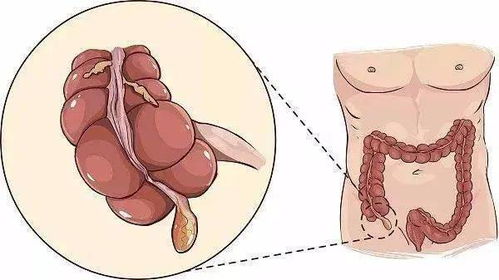 阑尾炎是哪个部位疼 位置图？阑尾在哪个位置图
