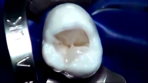 看看牙医是怎么修补一颗蛀牙的,补牙贵不是没有道理的,太赞了 