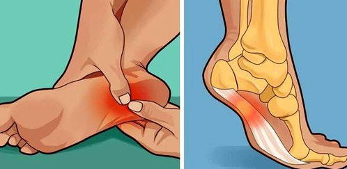 脚后跟部位的痛风急性发作与其它原因引起的脚后跟痛有什么不同