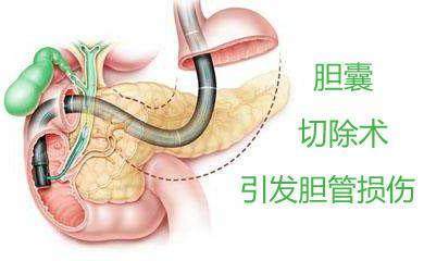 胆囊切除对身体有何影响 胆囊什么时候必须切 医生告诉你 