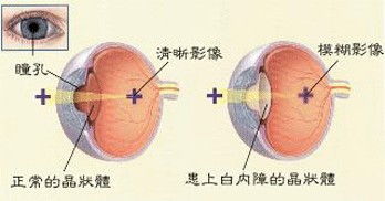 要是得了白内障必须动手术吗