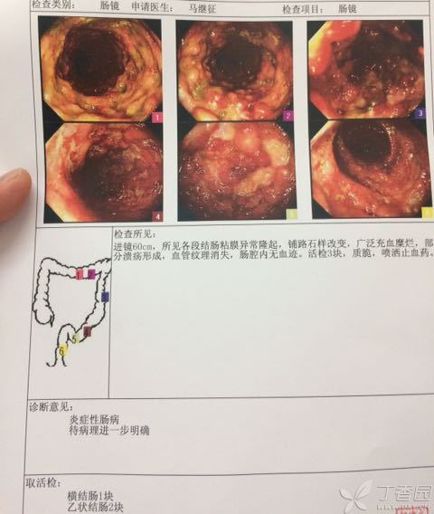 小肠镜医保报销吗 小肠镜在医保 