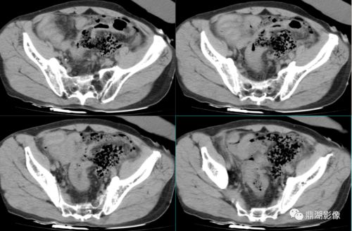 急诊放射必看 急腹症的常见影像学表现