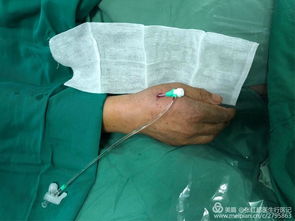 手背上介入 采用远端桡动脉穿刺技术建立动脉入路 