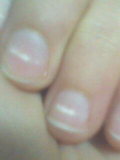 指甲中间出现白色条纹是什么原因 