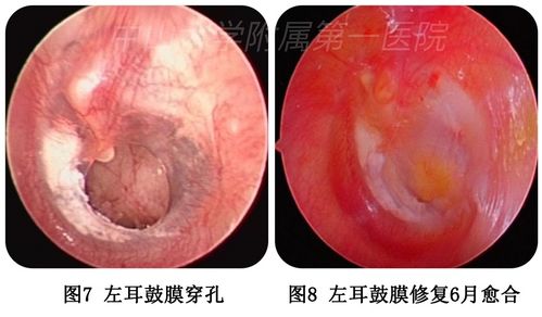 听力下降 耳痛难耐 耳朵鼓膜穿孔怎么办 专家来支招