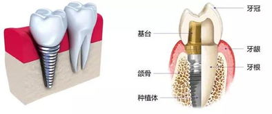 糖尿病不建议种牙吗女性