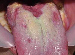 舌炎的症状及治疗,慢性舌炎的症状及治疗