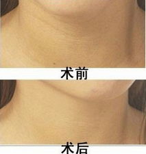 去颈部皱纹，如何消除颈纹最有效的方法