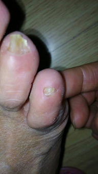 我的左右脚小脚趾的指甲盖变的这么小了,不疼不痒,挨着小趾的那个指头的指甲盖变厚了,是得了什么病吗, 