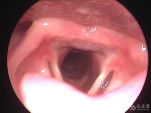 声带怪肿物 耳鼻咽喉 头颈外科专业版 爱爱医医学论坛 