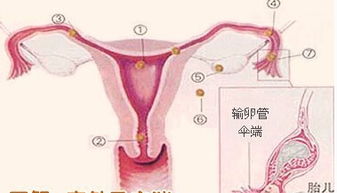 多次宫外孕威胁女性健康 四招避开宫外孕 雷区