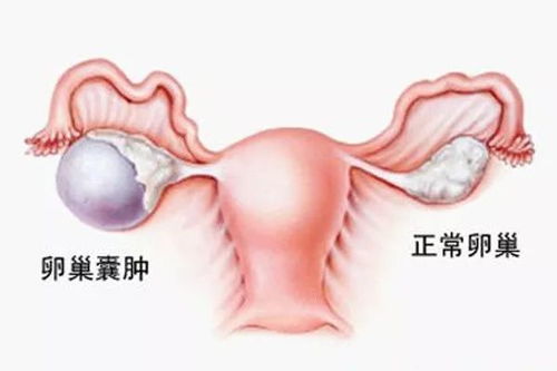 女性备孕患上巧克力囊肿,先手术还是先助孕 助孕专科联盟来帮你