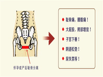 耻骨分离产后如何恢复,耻骨分离的症状