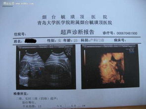 彩超单看胎儿性别，从彩超单上怎样看出胎儿性别