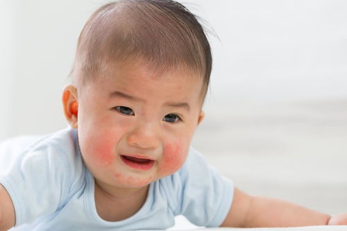 小儿过敏性湿疹(小孩过敏性湿疹如何改善)