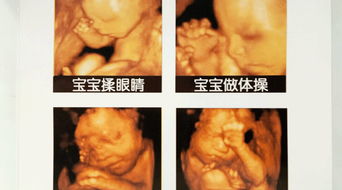 生命萌芽 艾玛妇产筛查胎儿畸形案例一览 
