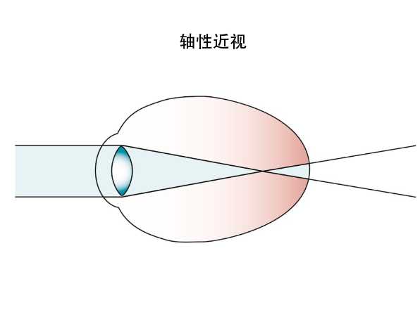 近视可以恢复为正常吗 假性近视是怎么回事