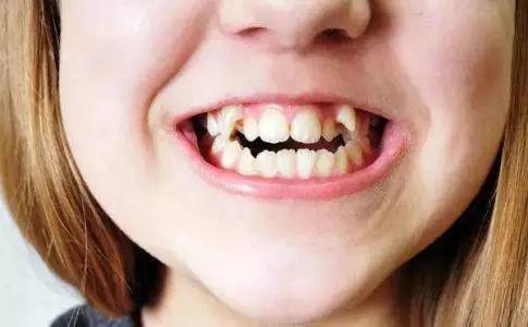 幼儿牙齿矫正的三个黄金期,直接影响孩子颜值,家长们要注意了