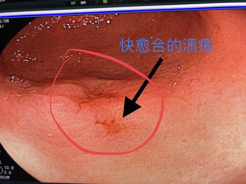 阳了，不用药可以吗会自愈吗